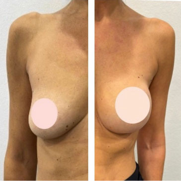 Aumento mamario en paciente
