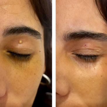 extirpacion de lesion cutanea benigna