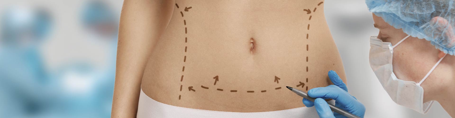 Reducción de abdomen