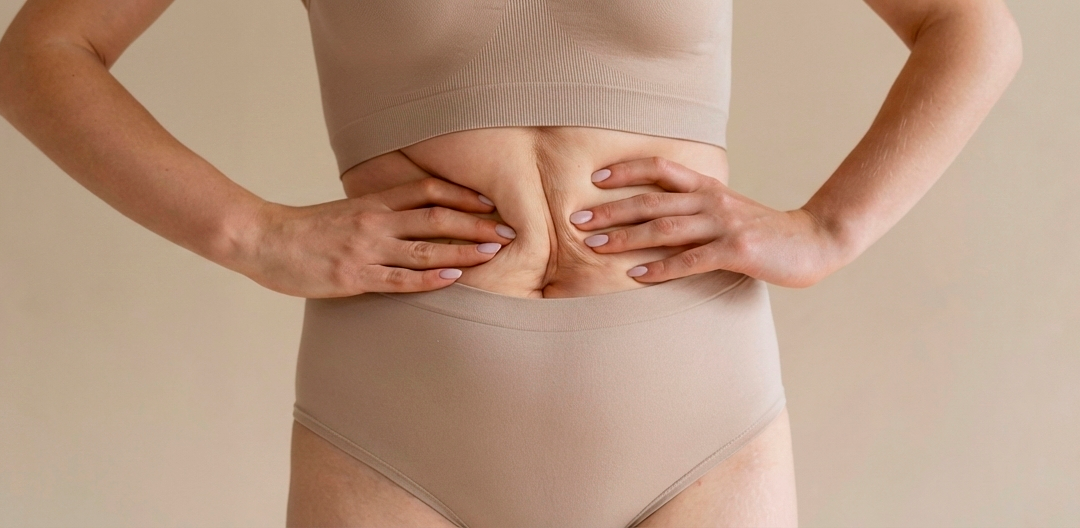 4 Mitos sobre la liposucción: lo que realmente debes saber