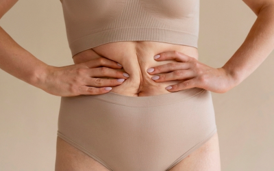 4 Mitos sobre la liposucción: lo que realmente debes saber